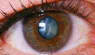 Delhi eye centre fined Rs 15 lakh for doing a shocking thing with a woman suffering from cataract
