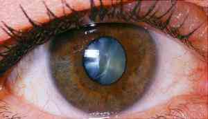 Delhi eye centre fined Rs 15 lakh for doing a shocking thing with a woman suffering from cataract