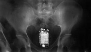 Kolkata: Shocking! Jail inmate caught with mobile phone, swallows device; what happened next will blow you hard!