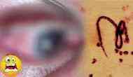 OMG! Doctor removes a large parasitic worm from man’s eyes; what happened next will give you goosebumps!