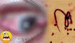 OMG! Doctor removes a large parasitic worm from man’s eyes; what happened next will give you goosebumps!