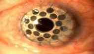 Weird! This woman has 500 holes in her eyes and the reason will give you goosebumps!
