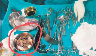 Karnataka: Doctors remove 187 coins from man’s stomach